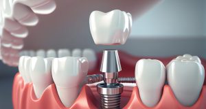 What do you need to know about dental implants in Turkey ?